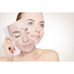 Opstartspakke til acne hud Ekseption